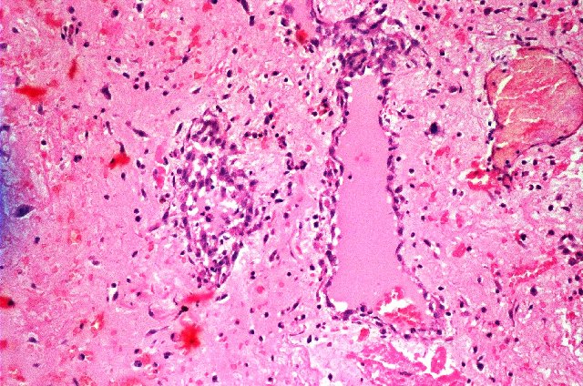 Figura 6. - Canal vascular formado por clulas mixoma en estroma fibroso. Hematoxilina & eosina, 40x.